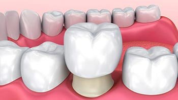 تيجان الاسنان في ايران