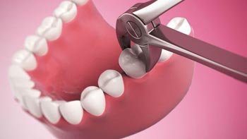 قلع الاسنان في ايران