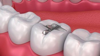 حشي الاسنان في ايران