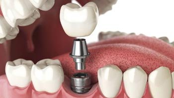 زراعة الاسنان في ايران