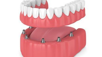 طقم الاسنان في ايران