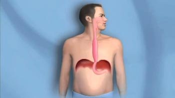 جراحة المري في ايران