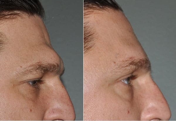 شد الجبين في ايران | افضل دكتور تجميل ومستشفى وتكلفة | سنا مدتور 3 قبل وبعد تحديد الجبهة في ايران