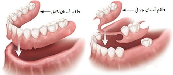 طقم الاسنان في ايران | افضل انواع ومواد ونتائج واسعار | سنا مدتور 4 طقم الاسنان الكامل و طقم الاسنان الجزئي