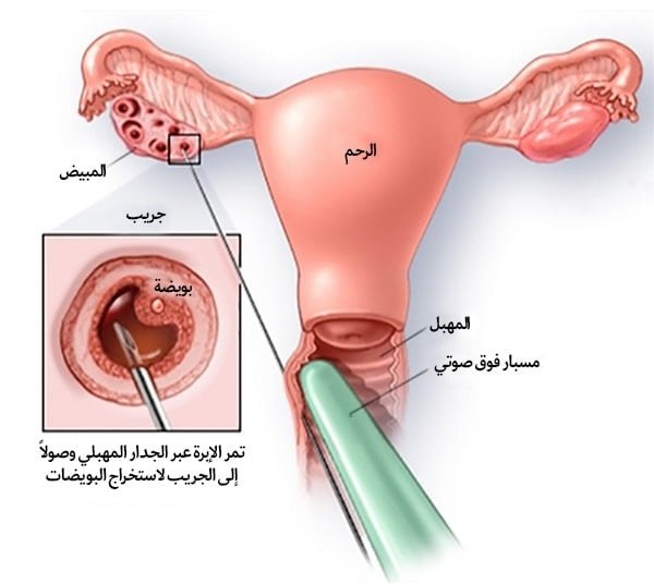 اطفال الانابيب في ايران | علاج العقم بافضل تكلفة و نتائج | سنا مدتور 3 كيفية اجراء عملية طفل الانبوب في ايران