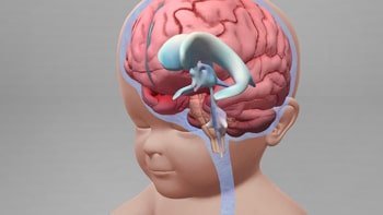 علاج استسقاء الرأس في ايران