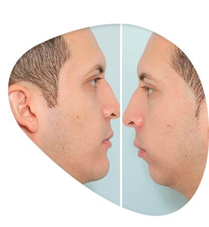 تجميل هيكل الفكين في ايران للرجال