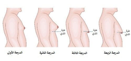 ازالة التثدي عند الرجال في ايران | افضل دكاترة و اسعار | سنا مدتور 3 عملية ازالة التثدي عند الرجال في ايران
