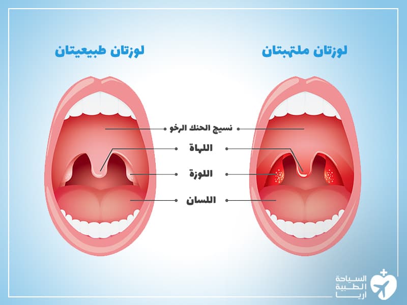 استئصال اللوزتين واللحمية في ايران | أفضل دكتور وتكلفة | سنا مدتور 2 استئصال اللوز والناميات في ايران