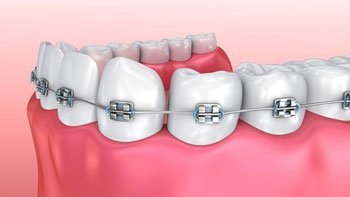 تقويم الاسنان في ايران | افضل اطباء و مواد و اسعار | سنا مدتور 1