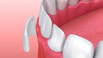 فينير الاسنان في ايران