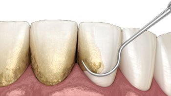 تنظيف الاسنان في ايران