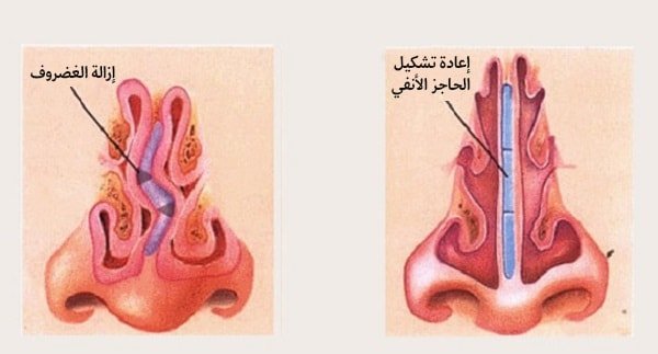 علاج انقطاع النفس النومي في ايران | افضل اطباء و مشافي و اسعار 4 انقطاع النفس النومي - رأب الحاجز الأنفي