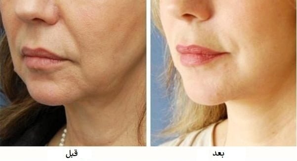 قبل وبعد الهايفو في ايران