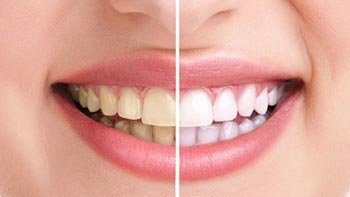 تبييض الاسنان في ايران