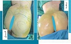 تكبير المؤخرة والارداف في ايران | افضل دكاترة و تكلفة | سنا مدتور 5 تكبير المؤخرة والارداف في ايران | افضل دكاترة و تكلفة | سنا مدتور 5