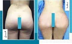 تكبير المؤخرة والارداف في ايران | افضل دكاترة و تكلفة | سنا مدتور 14 تكبير المؤخرة والارداف في ايران | افضل دكاترة و تكلفة | سنا مدتور 14