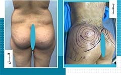 تكبير المؤخرة والارداف في ايران | افضل دكاترة و تكلفة | سنا مدتور 6 تكبير المؤخرة والارداف في ايران | افضل دكاترة و تكلفة | سنا مدتور 6