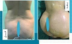 تكبير المؤخرة والارداف في ايران | افضل دكاترة و تكلفة | سنا مدتور 7 تكبير المؤخرة والارداف في ايران | افضل دكاترة و تكلفة | سنا مدتور 7