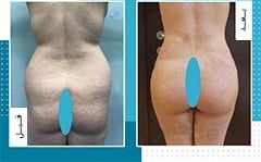 تكبير المؤخرة والارداف في ايران | افضل دكاترة و تكلفة | سنا مدتور 8 تكبير المؤخرة والارداف في ايران | افضل دكاترة و تكلفة | سنا مدتور 8