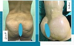 تكبير المؤخرة والارداف في ايران | افضل دكاترة و تكلفة | سنا مدتور 9 تكبير المؤخرة والارداف في ايران | افضل دكاترة و تكلفة | سنا مدتور 9