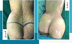 تكبير المؤخرة والارداف في ايران | افضل دكاترة و تكلفة | سنا مدتور 10 تكبير المؤخرة والارداف في ايران | افضل دكاترة و تكلفة | سنا مدتور 10