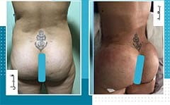 تكبير المؤخرة والارداف في ايران | افضل دكاترة و تكلفة | سنا مدتور 11 تكبير المؤخرة والارداف في ايران | افضل دكاترة و تكلفة | سنا مدتور 11