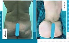 تكبير المؤخرة والارداف في ايران | افضل دكاترة و تكلفة | سنا مدتور 12 تكبير المؤخرة والارداف في ايران | افضل دكاترة و تكلفة | سنا مدتور 12