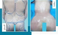 تكبير المؤخرة والارداف في ايران | افضل دكاترة و تكلفة | سنا مدتور 13 تكبير المؤخرة والارداف في ايران | افضل دكاترة و تكلفة | سنا مدتور 13