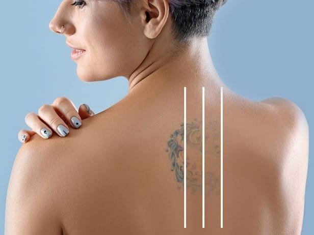 إزالة الوشم في ايران | أفضل نتائج وأجهزة وخبرة و تكلفة | سنا مدتور 1