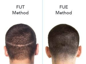 طريقة الشريحة FUT مقابل طريقة الاقتطاف FUE في زراعة الشعر 4 طريقة الشريحة FUT مقابل طريقة الاقتطاف FUE في زراعة الشعر 4