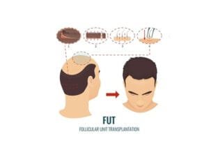 طريقة الشريحة FUT مقابل طريقة الاقتطاف FUE في زراعة الشعر 2 طريقة الشريحة FUT مقابل طريقة الاقتطاف FUE في زراعة الشعر 2