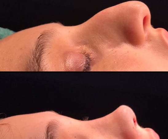 انواع الانف من وجهة نظر جراحة التجميل 7