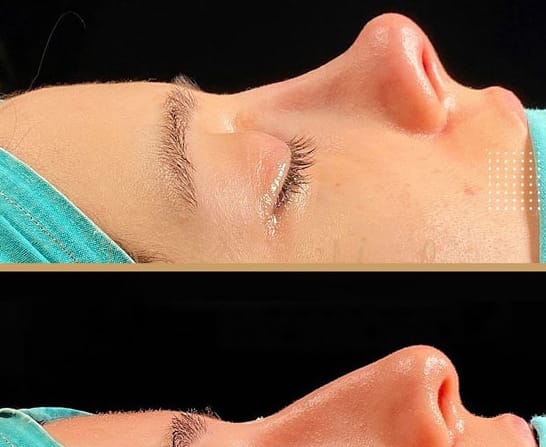 انواع الانف من وجهة نظر جراحة التجميل 6 انواع الانف من وجهة نظر جراحة التجميل 6