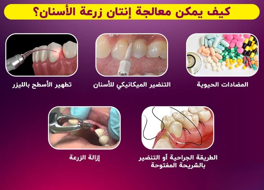 إنتان زرعة الأسنان: الأسباب والعلاجات 6 إنتان زرعة الأسنان: الأسباب والعلاجات 6