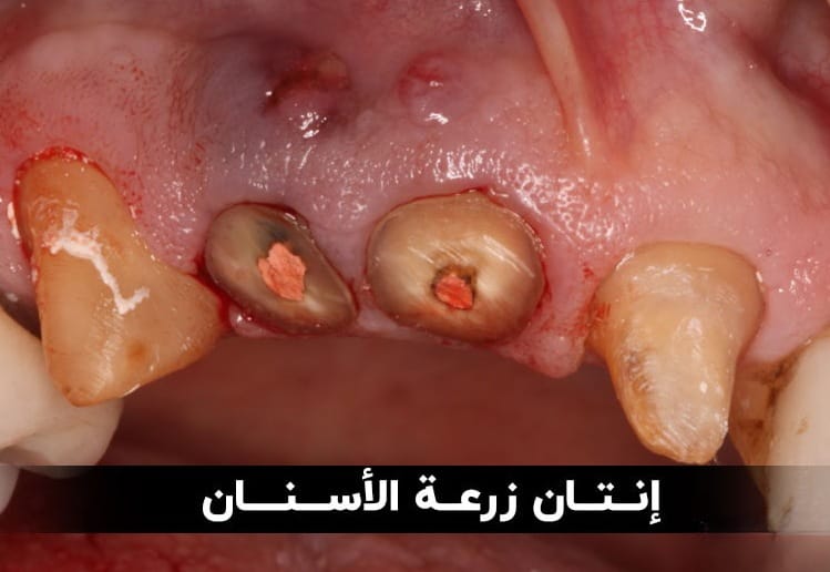 إنتان زرعة الأسنان: الأسباب والعلاجات 1 إنتان زرعة الأسنان: الأسباب والعلاجات 1