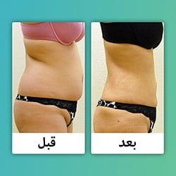 كم ينقص الوزن مع شفط الدهون؟