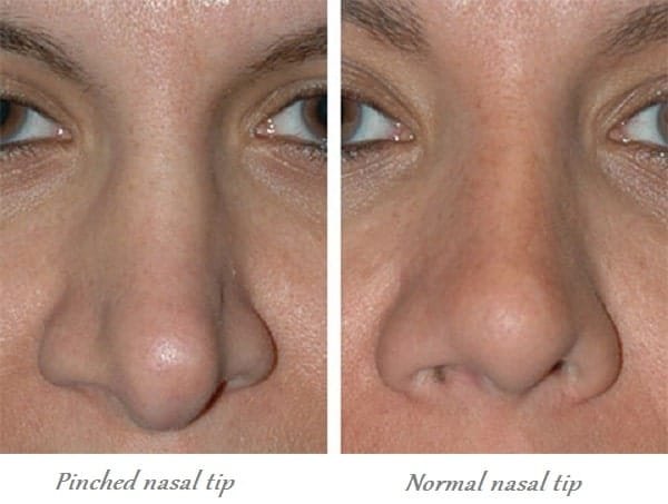 كيف يمكن التمييز إذا كان شخص ما قد أجرى عملية للأنف؟ 2