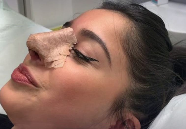 لماذا يجب علي وضع جبيرة على أنفي بعد عملية تجميل الأنف؟ 1 لماذا يجب علي وضع جبيرة على أنفي بعد عملية تجميل الأنف؟ 1