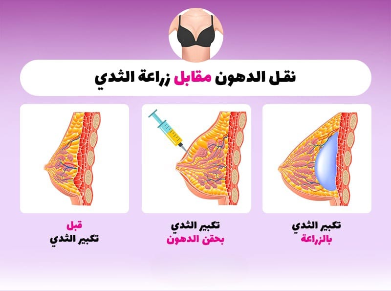 زراعة الثدي أم نقل الدهون: أي العمليتين يجب أن أقوم بإجرائها؟ 1 زراعة الثدي أم نقل الدهون: أي العمليتين يجب أن أقوم بإجرائها؟ 1