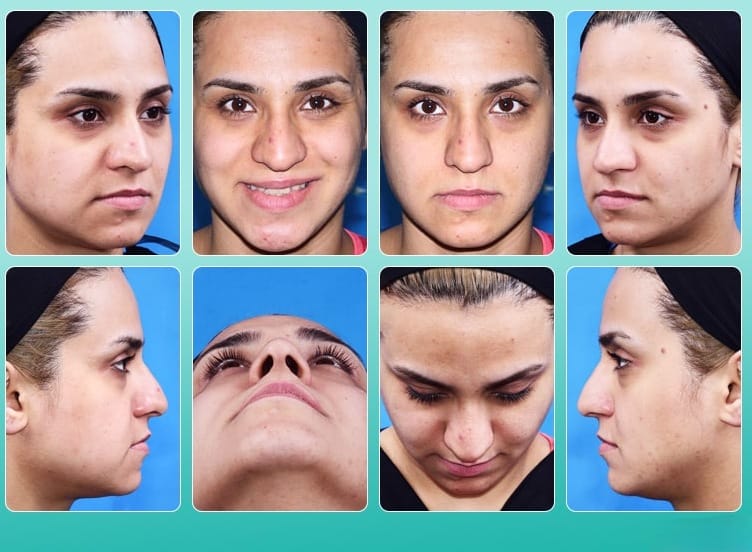 هل أنت مستعد لإجراء عملية الأنف؟ الدليل الشامل للاستعداد لعملية الأنف 3 هل أنت مستعد لإجراء عملية الأنف؟ الدليل الشامل للاستعداد لعملية الأنف 3
