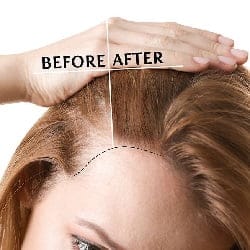 تخفيض خط الشعر أم زراعة الشعر: ما هو الفرق؟