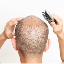 تساقط الشعر عند الرجال: الوقاية والعلاج