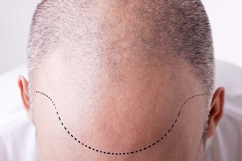 تخفيض خط الشعر أم زراعة الشعر: ما هو الفرق؟ 2 تخفيض خط الشعر أم زراعة الشعر: ما هو الفرق؟ 2