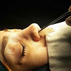 كل ما تحتاج معرفته حول حشو الانف بالسدادات الانفية بعد عملية تجميل الانف