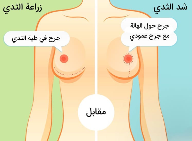 زراعة الثدي أم شد الثدي: أي منهما أنسب لي؟ 3 زراعة الثدي أم شد الثدي: أي منهما أنسب لي؟ 3