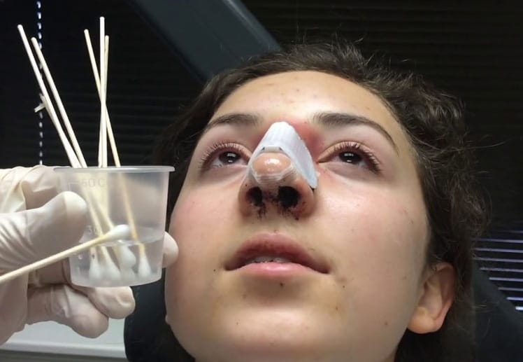 كيف أنظف أنفي بعد عملية تجميل الانف؟ 3 كيف أنظف أنفي بعد عملية تجميل الانف؟ 3
