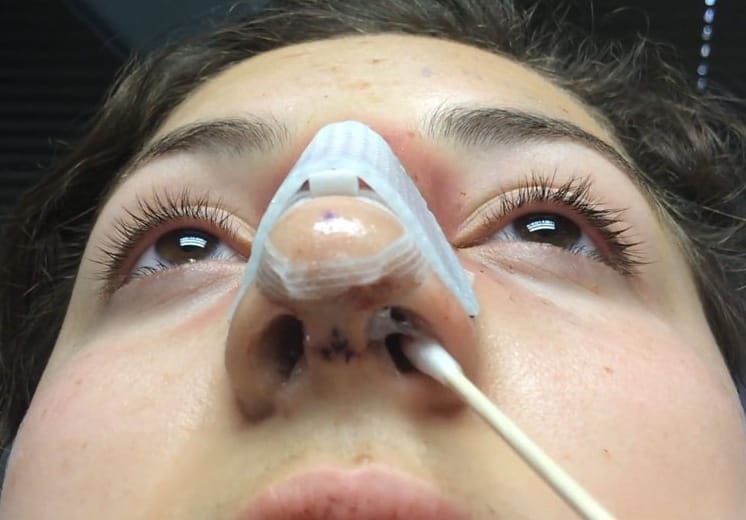 كيف أنظف أنفي بعد عملية تجميل الانف؟ 4 كيف أنظف أنفي بعد عملية تجميل الانف؟ 4