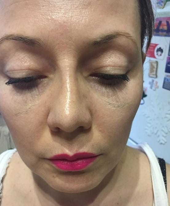 مضاعفات ومخاطر عملية تجميل الانف 2 مضاعفات ومخاطر عملية تجميل الانف 2