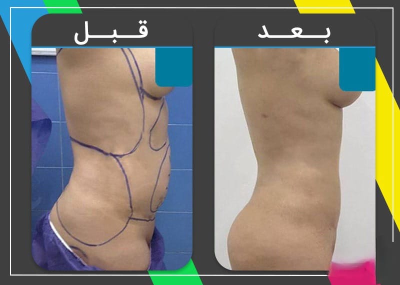 كيف يجب أن أستعد لعملية شفط الدهون؟ 5 كيف يجب أن أستعد لعملية شفط الدهون؟ 5